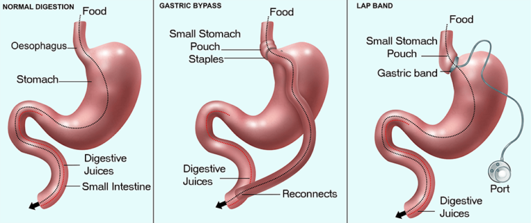 Bariatric Surgery for Lasting Weight Loss