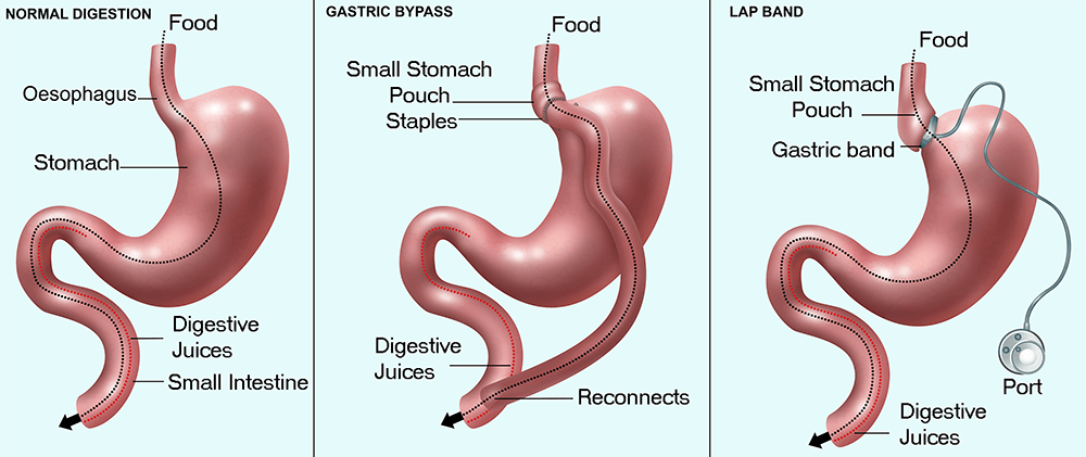 Bariatric Surgery: A Lifeline for Lasting Weight Loss